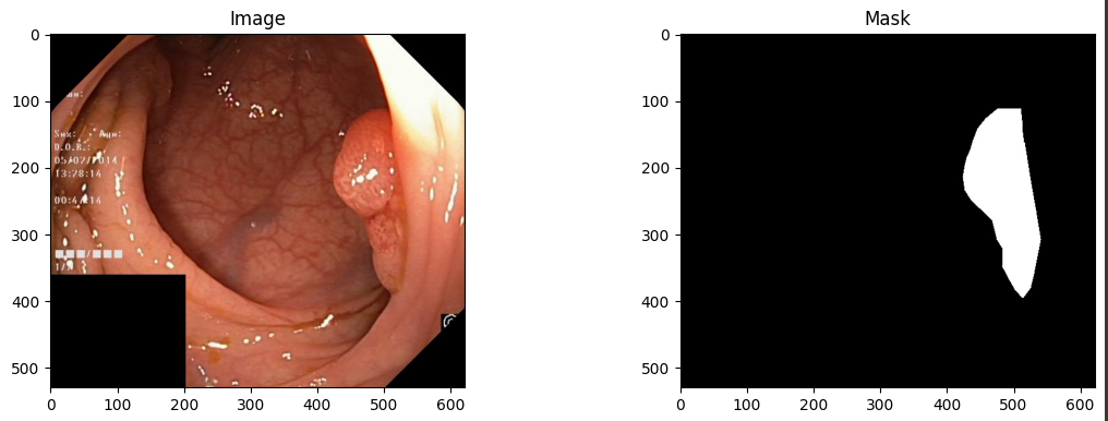 Polyp segmentation